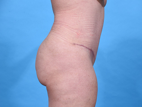 Tummy Tuck After - Miami, FL