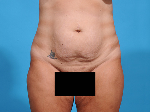 Tummy Tuck Before - Miami, FL