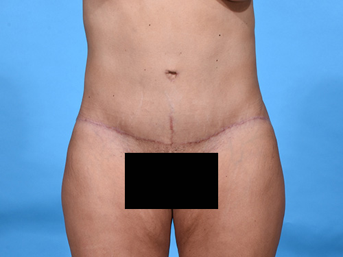 Tummy Tuck After - Miami, FL