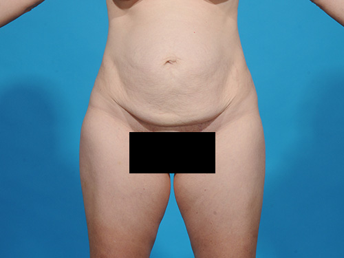 Tummy Tuck Before - Miami, FL