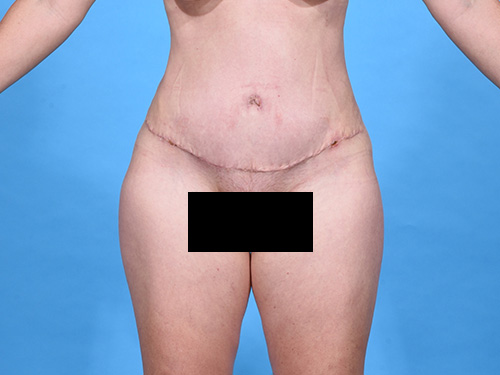 Tummy Tuck After - Miami, FL